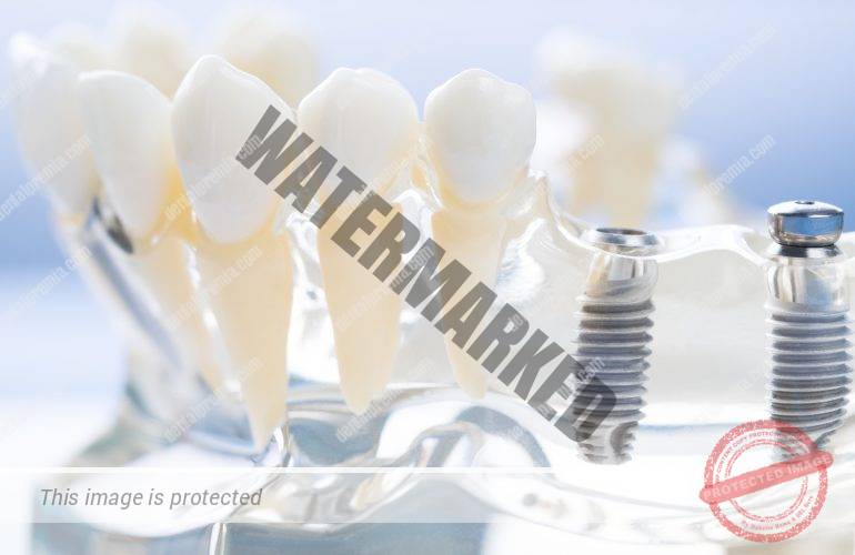 imagen de implantes dentales premia