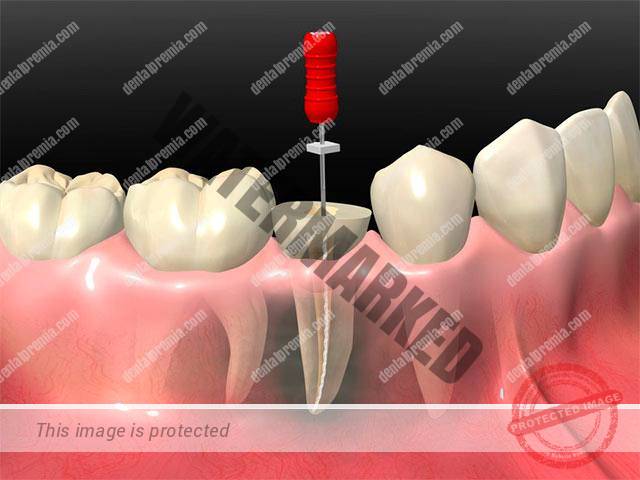 imagen de endodoncia clinica dental Premià