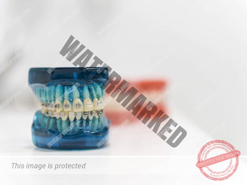 imagen de brackets dental premia