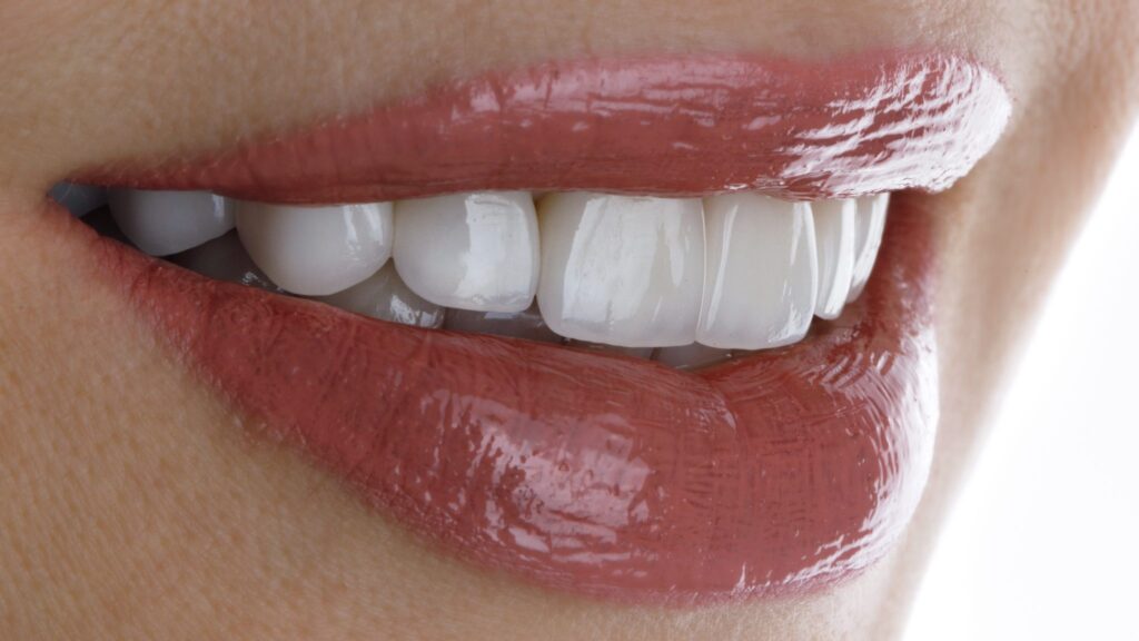 Dientes perfectos. Sonrisa alineada y blanca