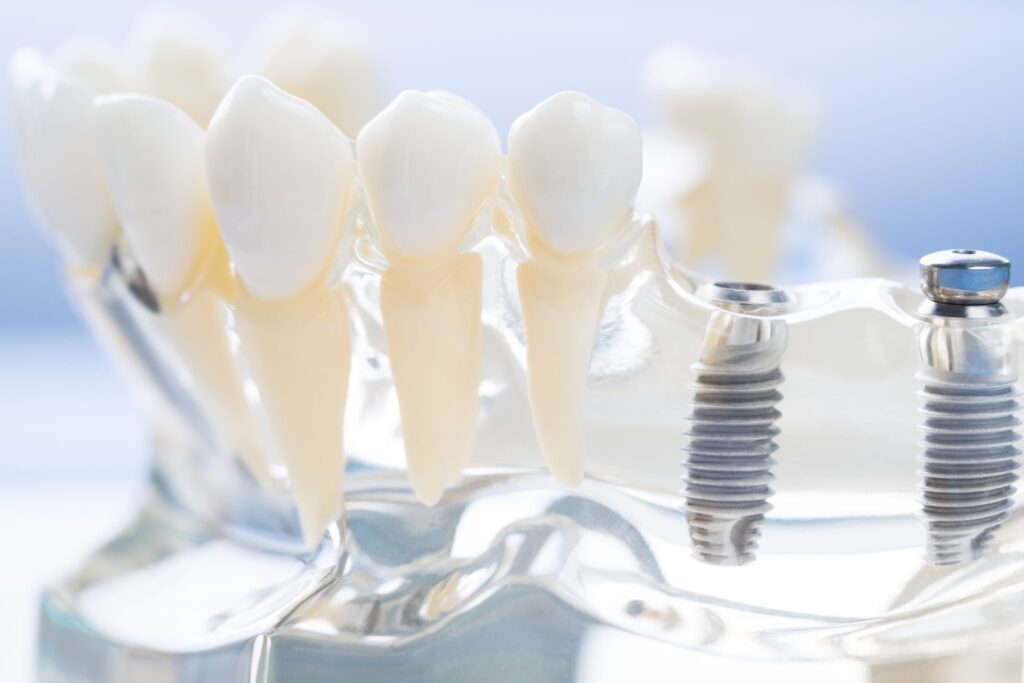 Implante dental en Barcelona