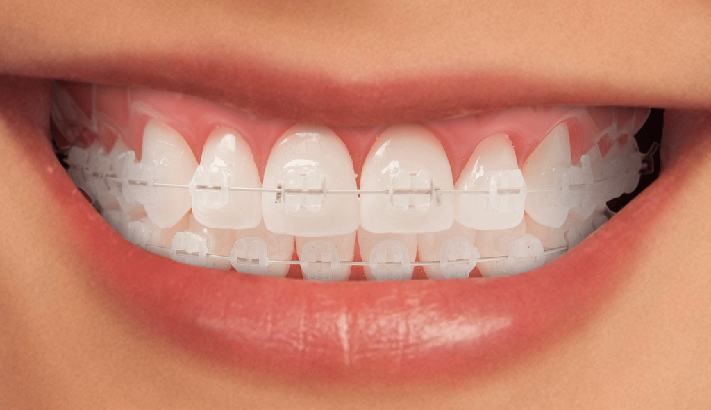 Ortodoncia con brackets en Premià de Dalt, Barcelona
